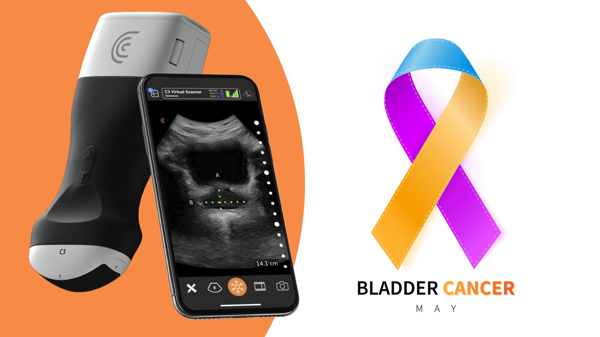 Ultrasound and Bladder Cancer