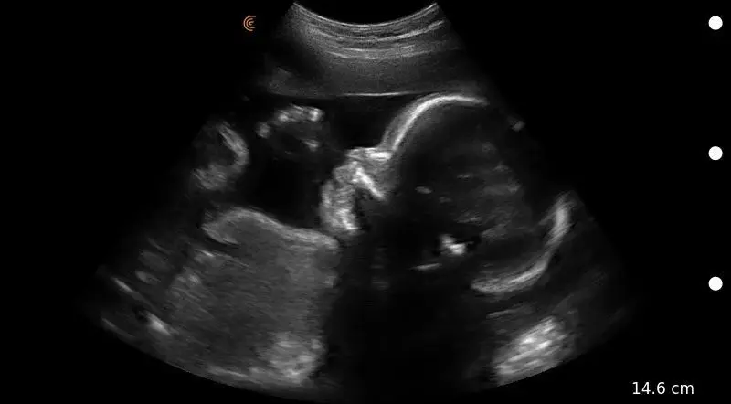 Fetal Profile