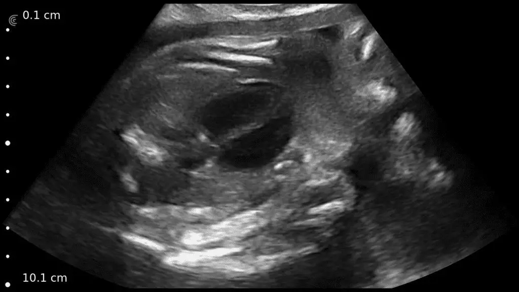 fetal heart clinical image